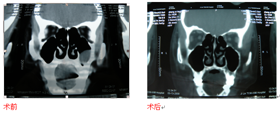 【耳鼻喉科】中西合璧的微創(chuàng)鼻內(nèi)鏡外科